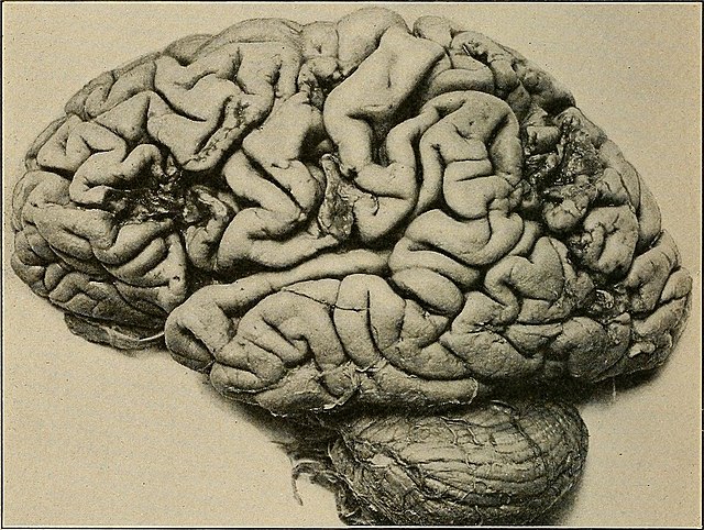 BREAKING: US Government Colluding With Medical Community To Classify Horrific Covid-19 Vaccine Neurological Injuries As 'Anxiety'