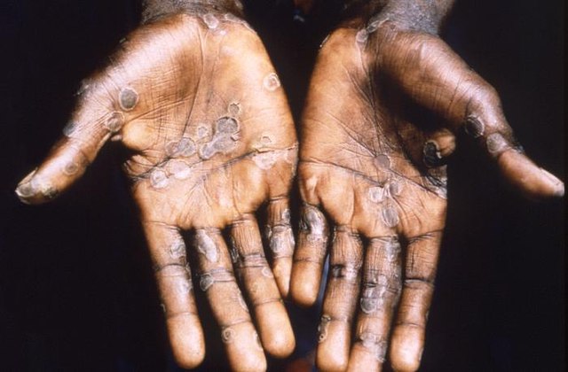 Monkeypox Outbreak In Congo