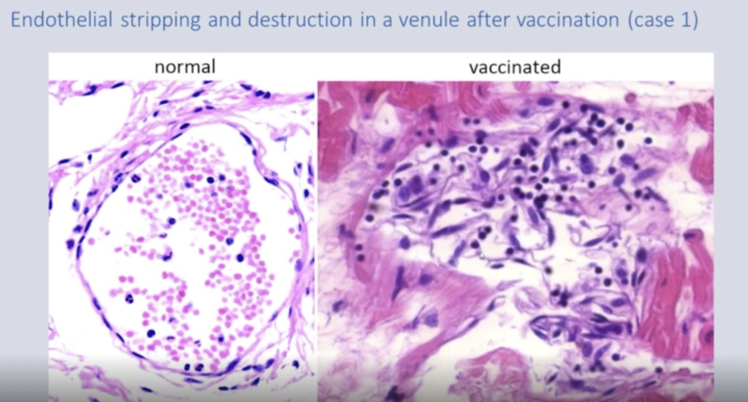 Pathologists Are Unaware Of The Pathogen Killing The Vaccinated - A Consequence Of Medical Journal Censorship