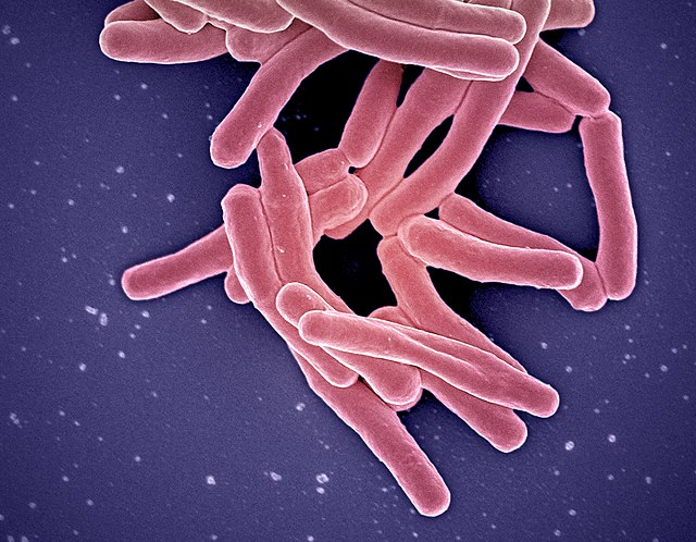 Tuberculosis rates have rebounded after decades of decline thanks to open borders.