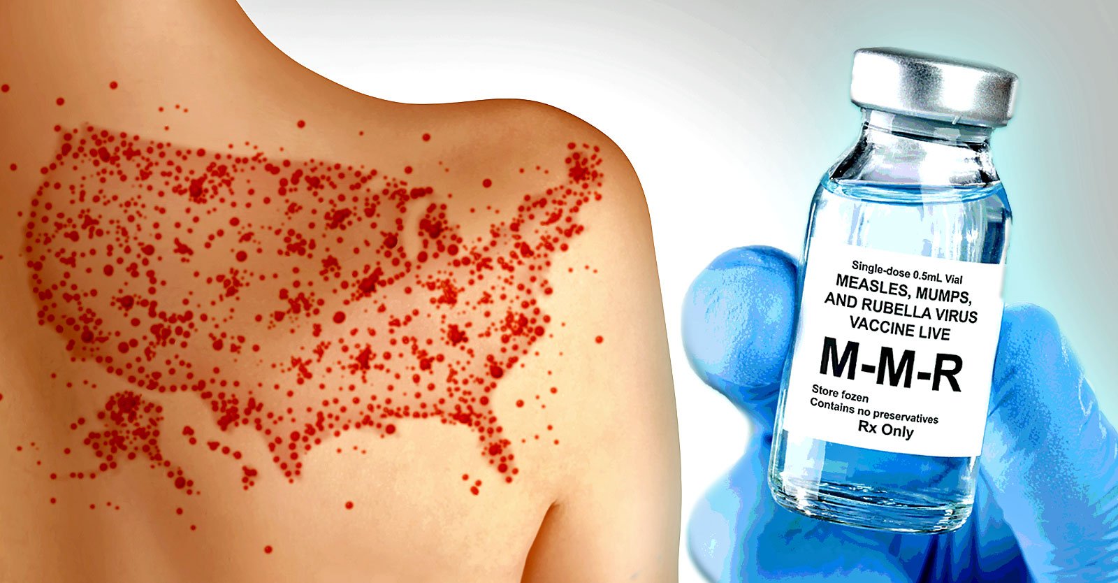 Latest Measles Outbreaks a Result Of Failed Vaccines — Not Failure To Vaccinate